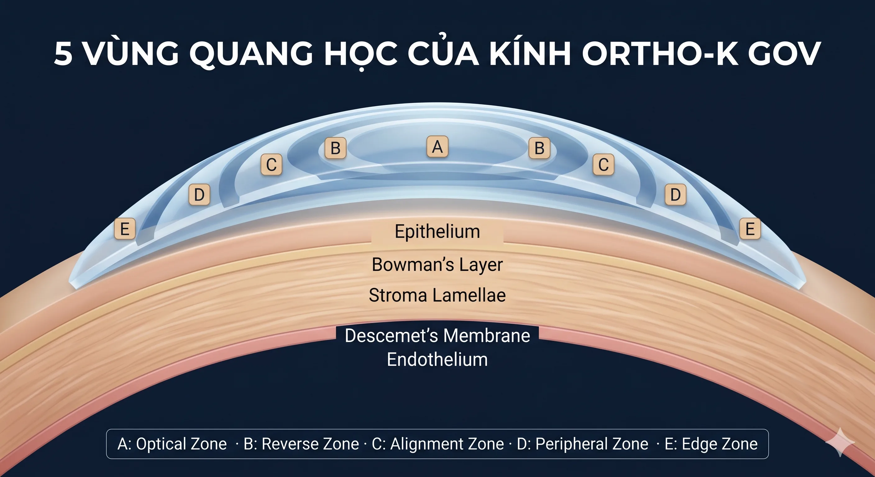 5 vùng quang học của kính Ortho-K GOV® — Optical Zone · Reverse Zone · Alignment Zone · Peripheral Zone · Edge Zone